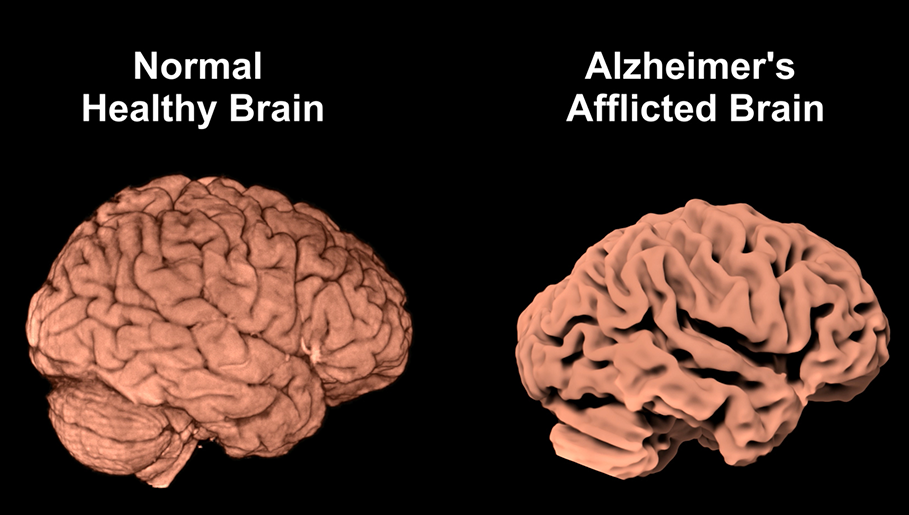 /SVG/new_svg_images/Normal_and_Alzheimers_Brains.png